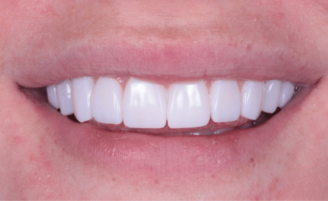 After composite bonding