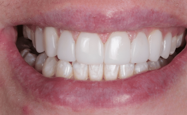 After porcelain veneers